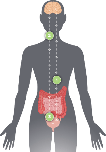 How Sacral Neuromodulation Works - Nerve Signal Diagram